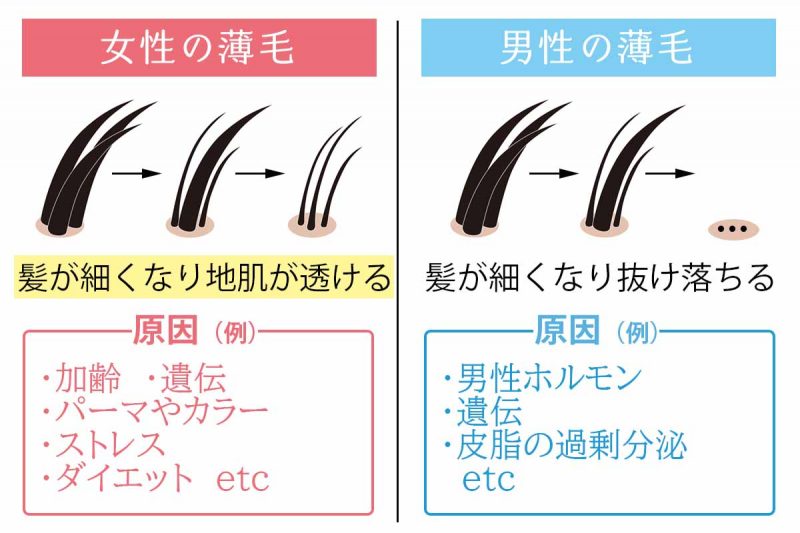 リリィジュ 男女の薄毛の違い